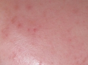 case-acne 01-after.webp