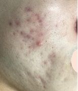 case-acne 02-after.webp