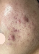 case-acne 03-before.webp