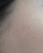 case-spot-A-luby-laser-after.webp