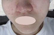case-acne 03-after.webp