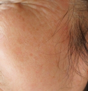 case-spot-C-IPL-after.webp