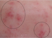 case-acne 01-before.webp