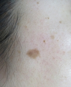 case-spot-A-luby-laser-before.webp