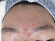 case-acne 04-before.webp