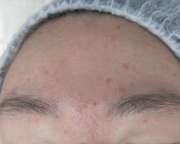 case-acne 04-after.webp