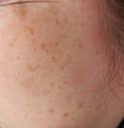 case-spot-C-IPL-before.webp