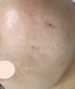 case-acne 03-after.webp