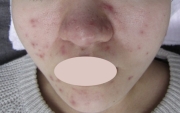 case-acne 03-before.webp