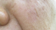 case-spot-B-luby-laser-after.webp
