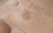 case-spot-B-luby-laser-before.webp