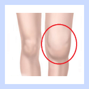 膝関節の理学検査における水腫（関節内への水たまり）の比較図。正常な膝と、炎症によって腫れが生じている膝を並べ、赤丸でエラー箇所（水腫）を強調。膝痛や可動域制限の根本原因を特定する動態分析のイメージ。