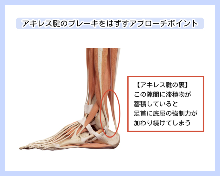 アキレス腱の裏側の隙間に滞積物が蓄積し、足首に底屈の強制力が加わり続けている状態を示す解剖図。