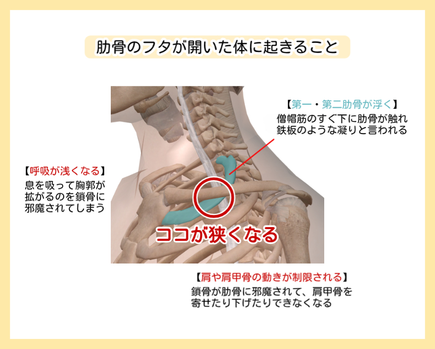 第一・第二肋骨が浮き上がり「肋骨のフタ」が開いた状態の解説図。跳ね上がった肋骨が鎖骨との隙間を狭くし、呼吸の浅さや肩甲骨の可動域制限、首の鉄板のような凝りを引き起こしているメカニズムを示しています。