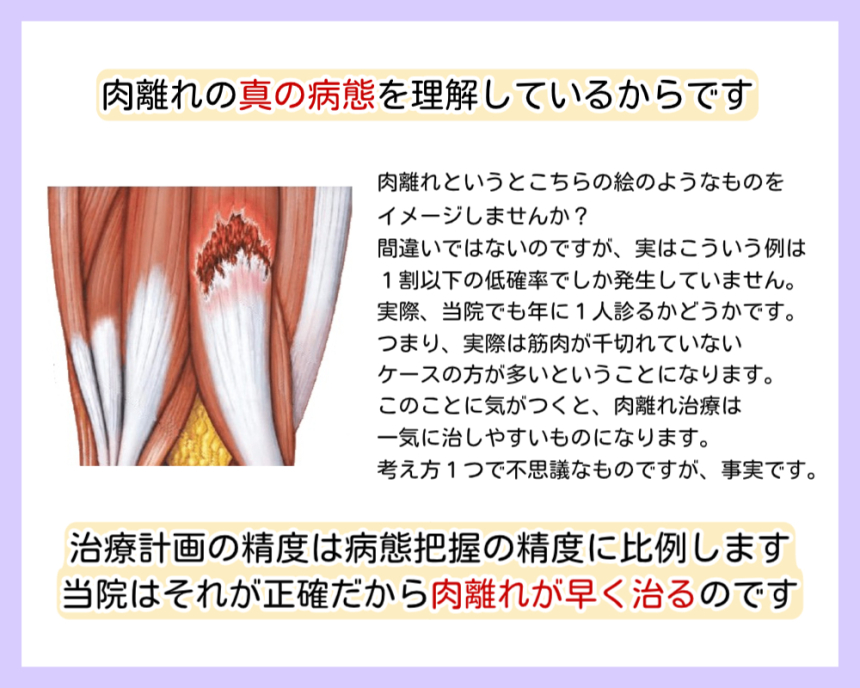 肉離れの真の病態について説明している画像です