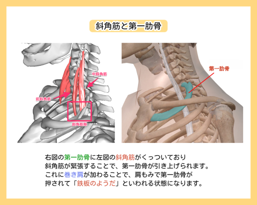 斜角筋と第一肋骨の解剖図。前斜角筋・中斜角筋が第一肋骨を吊り上げる仕組みと、巻き肩によって第一肋骨が表面に露出し、肩もみで「鉄板のような硬さ」と誤認されるメカニズムの解説。