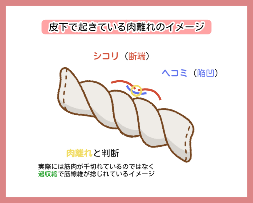 皮下で起きている肉離れの物理メカニズム図解。筋肉が千切れている（断裂）のではなく、過収縮で筋線維が捻じれている状態をタオルに例えて解説。タオルを強く捻ることで生じる「コブ」が肉離れのシコリ（断端）であり、その隣の溝がヘコミ（陥凹）の正体であることを示す。東京・神楽坂「神楽坂整体たいむ」独自の肉離れ古傷解消理論。