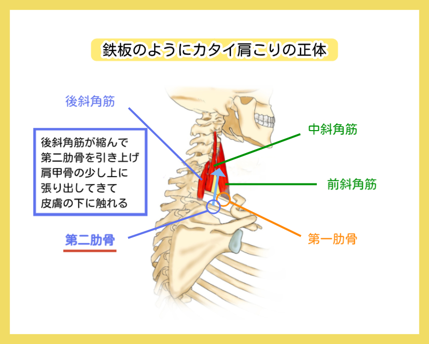 鉄板のようにカタイ肩こりの正体：後斜角筋が第二肋骨を引き上げるメカニズム解説図