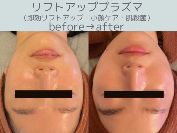 ビフォーアフター1