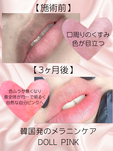 ドールピンク施術イメージ